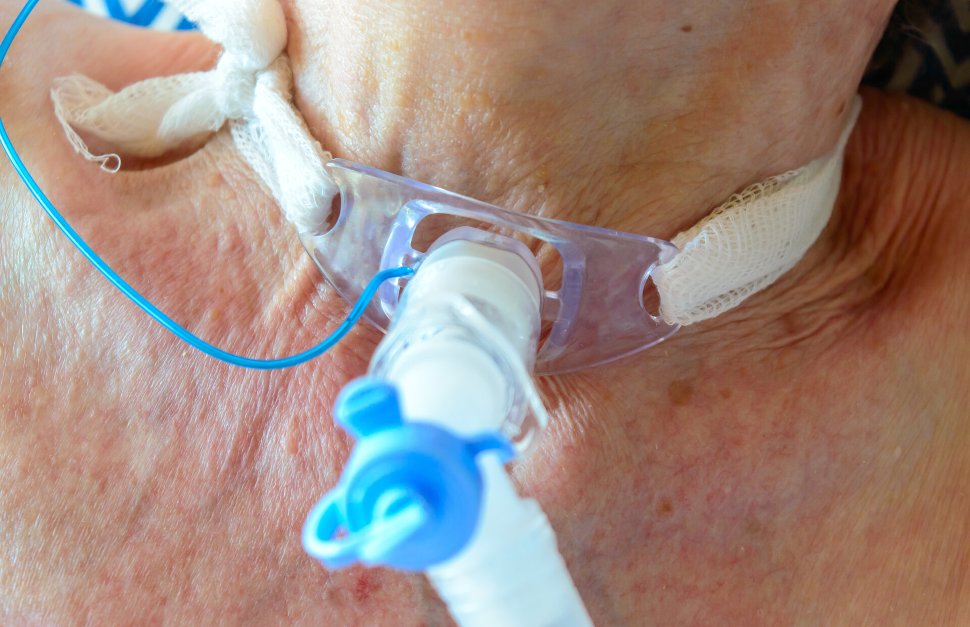 Person with tracheostomy tube breathing support