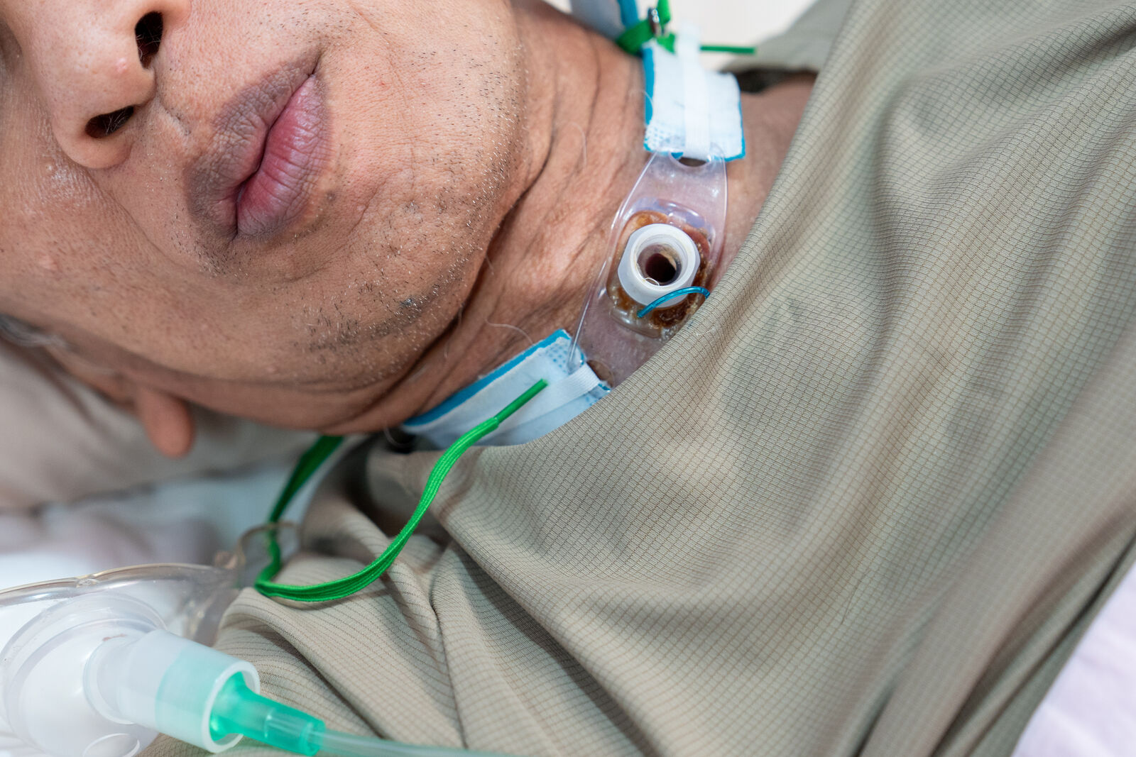 Tracheostomy patient care in adult family home